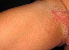 psoriasis after